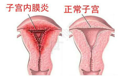 全自动阴道分泌物樱花草视频在线观看高清免费资源厂家子宫内膜炎的症状表现提前了解与预防